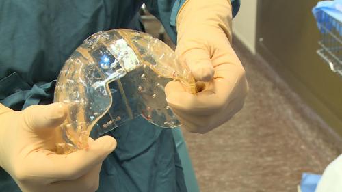 أطباء ينجحوا في زراعة جمجمة بلاستيكية  لسيدة 