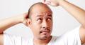  باحثون يابانيون يبتكرون طريقة جديدة لزراعة الشعر