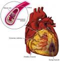 أمراض القلب تحصد أرواح 1.1 مليون شخص سنوياُ